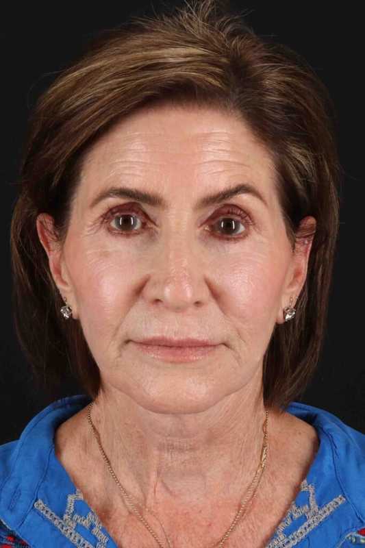 Facelift Before & After Patient #5337