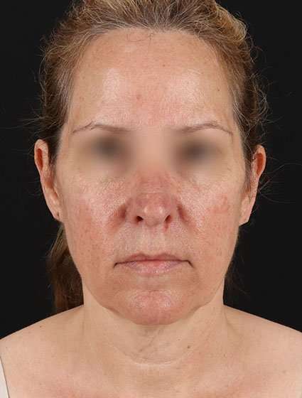 Facelift Before & After Patient #5359