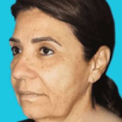 Facelift Before & After Patient #5362