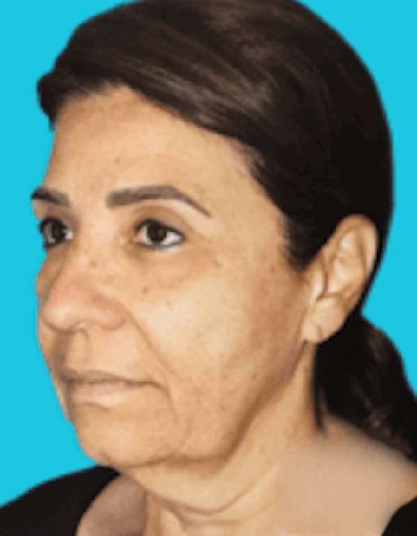 Facelift Before & After Patient #5362