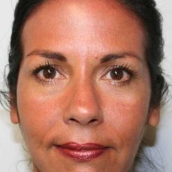 Facelift Before & After Patient #5367
