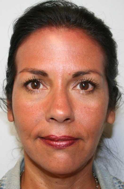Facelift Before & After Patient #5367