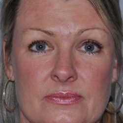 Facelift Before & After Patient #5385