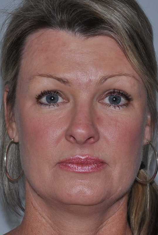 Facelift Before & After Patient #5385
