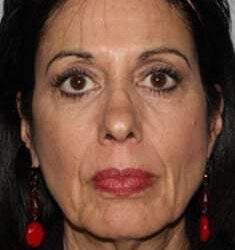 Facelift Before & After Patient #5399