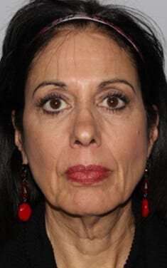 Facelift Before & After Patient #5399