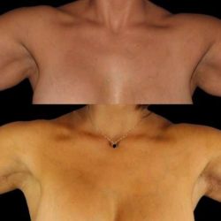 Brachioplasty (Arm Lift) Before & After Patient #1125
