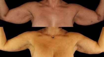 Brachioplasty (Arm Lift) Before & After Patient #1125