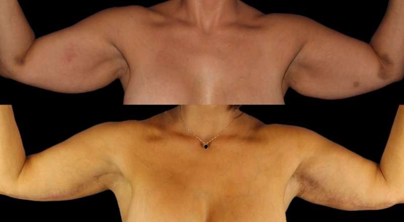 Brachioplasty (Arm Lift) Before & After Patient #1125
