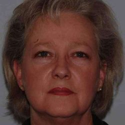Facelift Before & After Patient #5424