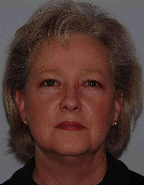 Facelift Before & After Patient #5424
