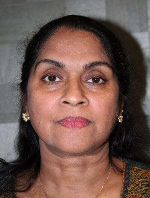 Facelift Before & After Patient #5431