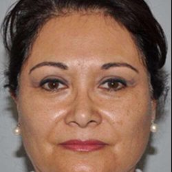 Facelift Before & After Patient #5438