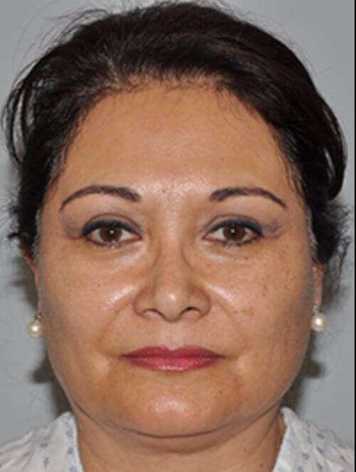 Facelift Before & After Patient #5438