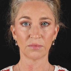 Facelift Before & After Patient #5488