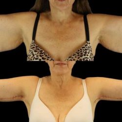 Brachioplasty (Arm Lift) Before & After Patient #1128