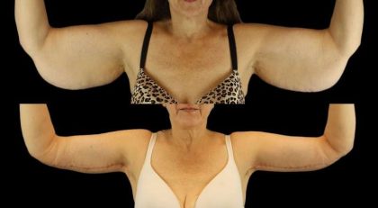 Brachioplasty (Arm Lift) Before & After Patient #1128