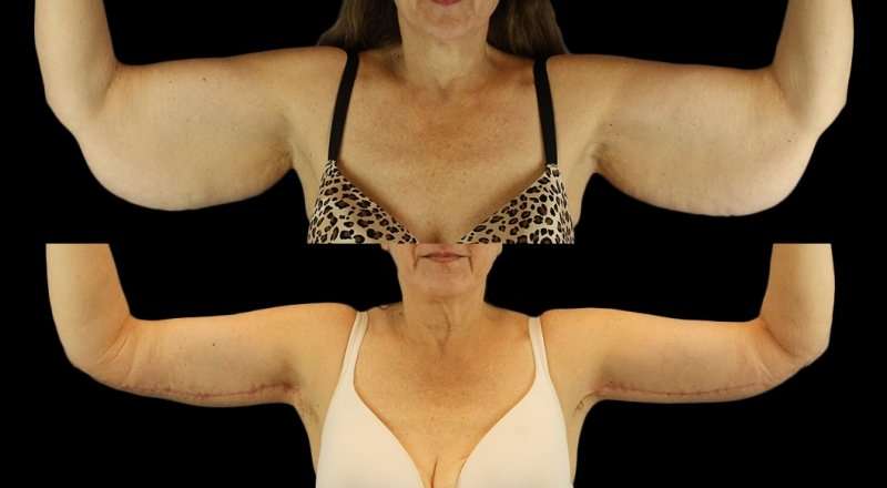 Brachioplasty (Arm Lift) Before & After Patient #1128