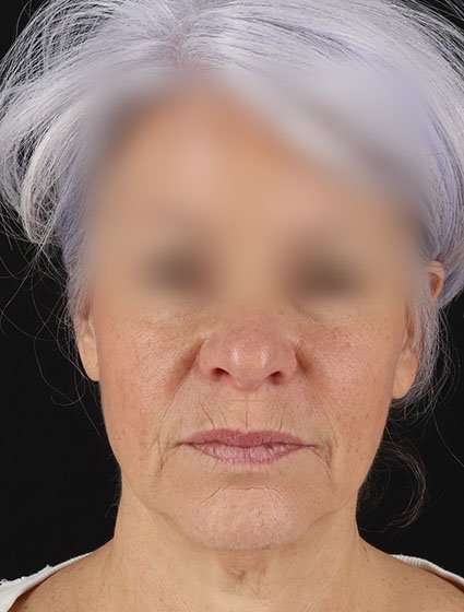 Facelift Before & After Patient #5499