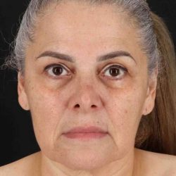 Facelift Before & After Patient #5510