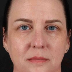 Facelift Before & After Patient #5521