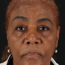 Chemical Peels Before & After Patient #5554