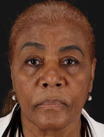 Chemical Peels Before & After Patient #5554