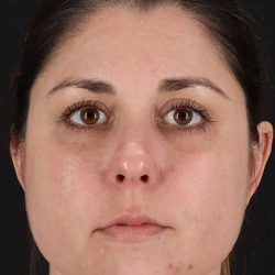 Chemical Peels Before & After Patient #5557