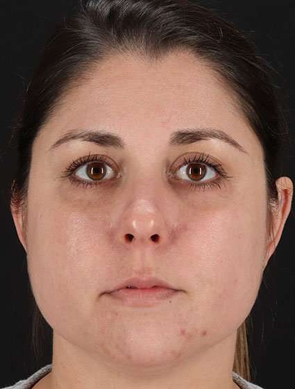 Chemical Peels Before & After Patient #5557