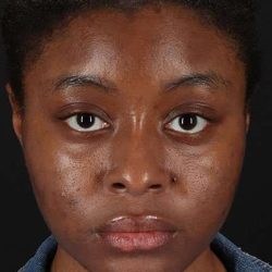 Chemical Peels Before & After Patient #5568