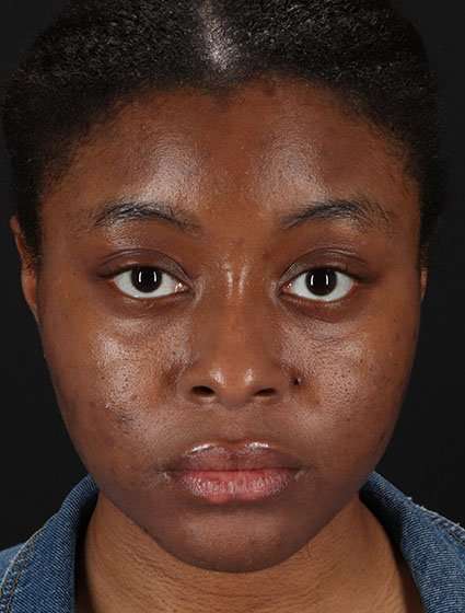 Chemical Peels Before & After Patient #5568