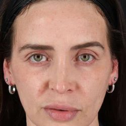 Chemical Peels Before & After Patient #5579