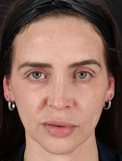 Chemical Peels Before & After Patient #5579