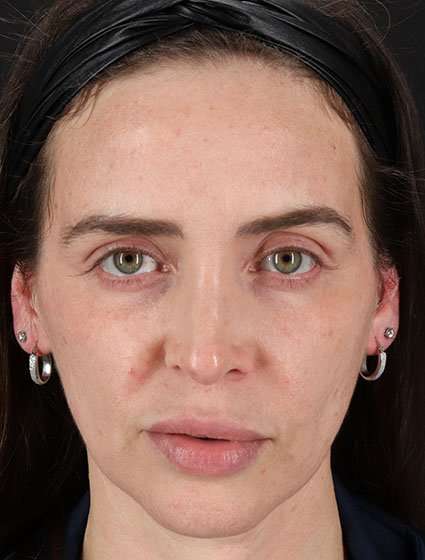 Chemical Peels Before & After Patient #5579