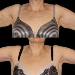 Brachioplasty (Arm Lift) Before & After Patient #1131