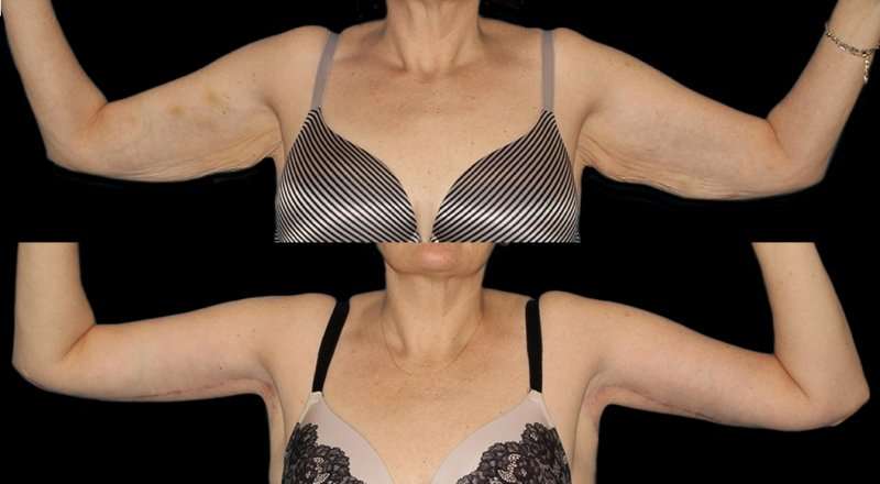 Brachioplasty (Arm Lift) Before & After Patient #1131
