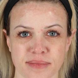 Chemical Peels Before & After Patient #5601