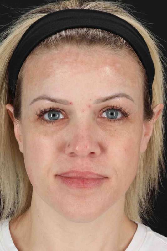 Chemical Peels Before & After Patient #5601