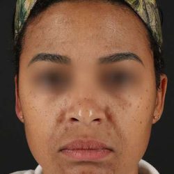 Chemical Peels Before & After Patient #5610