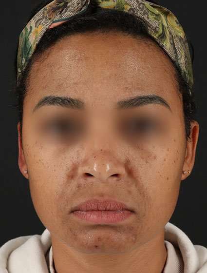 Chemical Peels Before & After Patient #5610