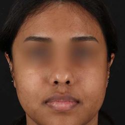 Chemical Peels Before & After Patient #5621