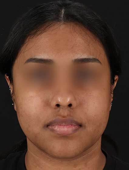 Chemical Peels Before & After Patient #5621