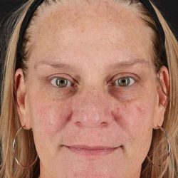 Chemical Peels Before & After Patient #5632