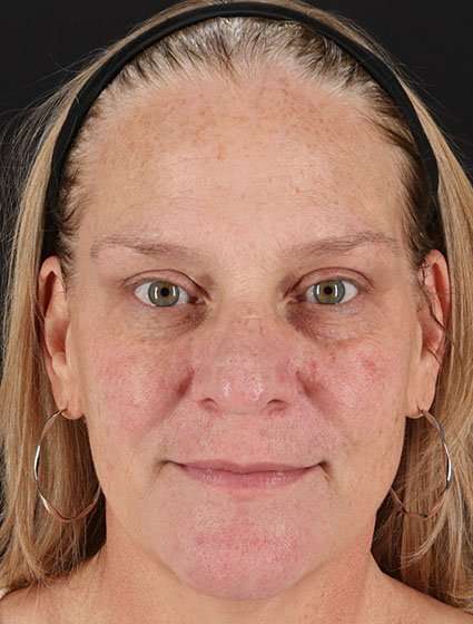 Chemical Peels Before & After Patient #5632