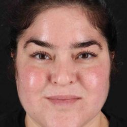 Neck Liposuction Before & After Patient #5643