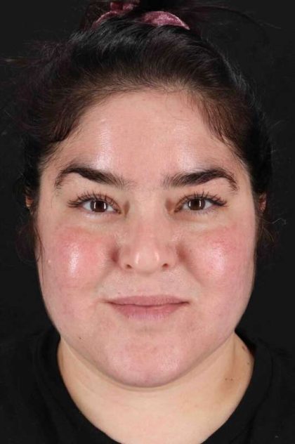 Neck Liposuction Before & After Patient #5643
