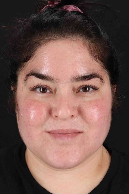 Neck Liposuction Before & After Patient #5643
