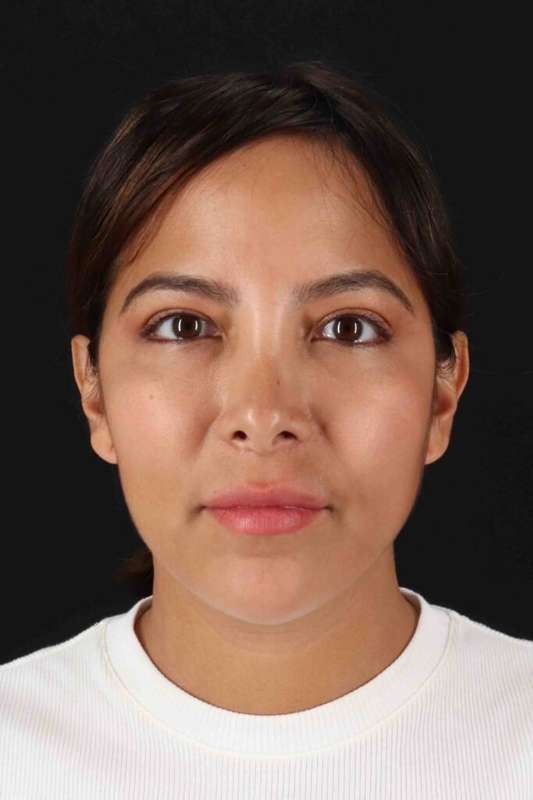 Neck Liposuction Before & After Patient #5654