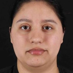 Neck Liposuction Before & After Patient #5665