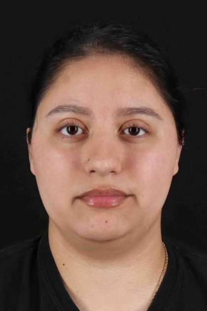 Neck Liposuction Before & After Patient #5665